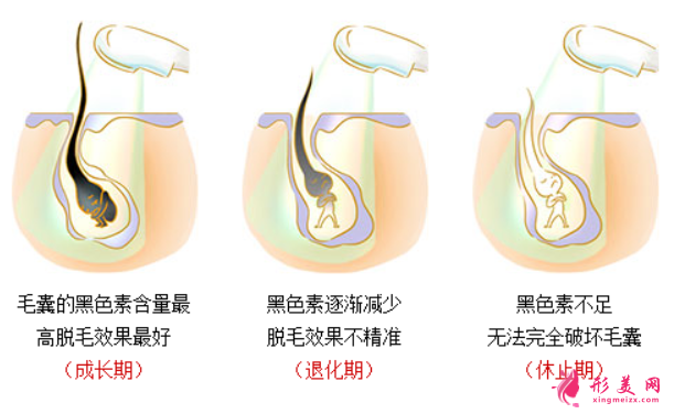 激光脫毛會(huì)有損傷皮膚嗎