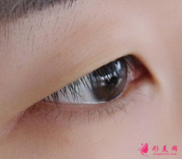 腫泡眼可以割雙眼皮嗎？