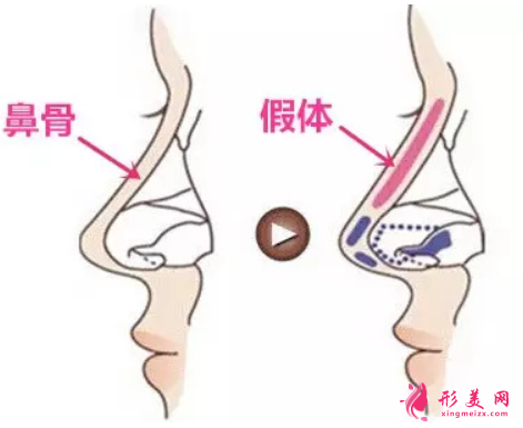 做假體隆鼻后可以洗臉嗎