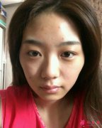 深圳非凡整形醫(yī)院面部填充好嗎？真實(shí)案例分享