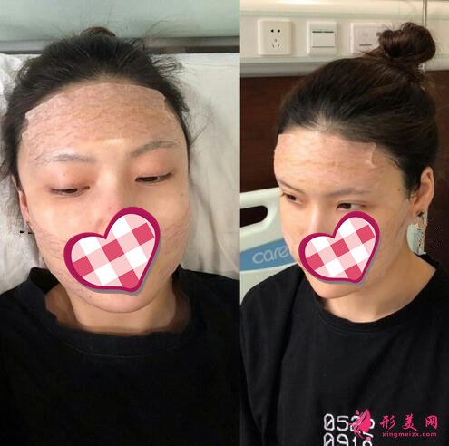 深圳美麗方案醫(yī)療美容姚堯自體脂肪填充心形臉案例