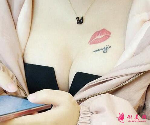 劉月更醫(yī)生隆胸手術(shù)效果圖