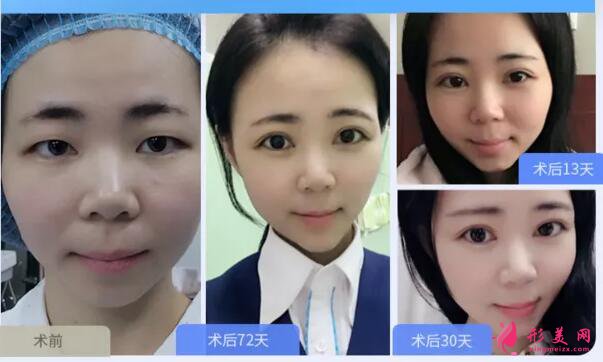 深圳做開內(nèi)眼角多少錢?