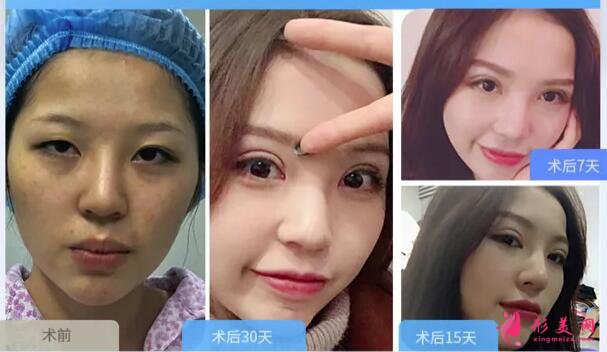 深圳做開內(nèi)眼角多少錢?