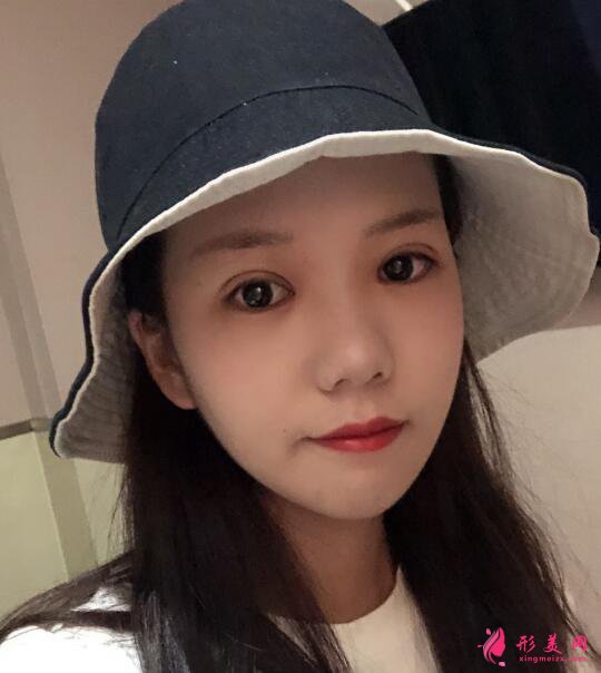 準(zhǔn)備做雙眼皮