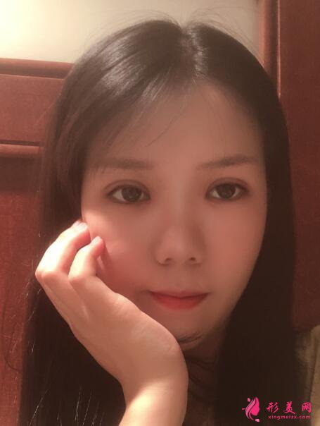 準(zhǔn)備做雙眼皮