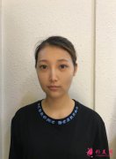 武漢美加壹整形醫(yī)院做脂肪填充好不好?附2020價(jià)格表和案例分享