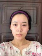 南京南醫(yī)二附院整形價格表及雙眼皮隆鼻案例分享