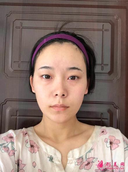 深圳美萊雙眼皮隆鼻案例圖鑒賞，糟糕，是心動的感覺~
