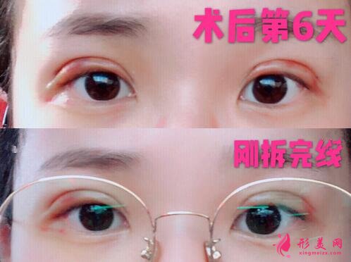深圳米蘭柏羽做眼睛怎么樣？這個案例圖告訴你答案