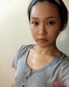 湖南省人民醫(yī)院整形科假體隆胸怎么樣？隆胸前后對(duì)比圖