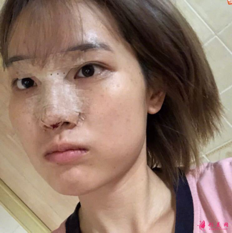 深圳領醫(yī)醫(yī)療美容隆鼻怎么樣