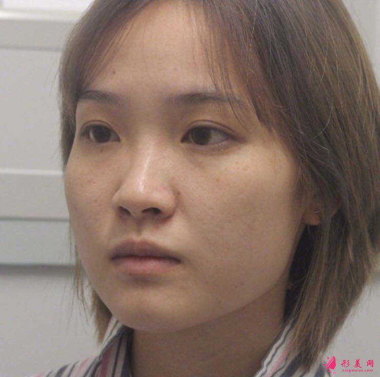 深圳領醫(yī)醫(yī)療美容醫(yī)美怎么樣？隆鼻案例分享！