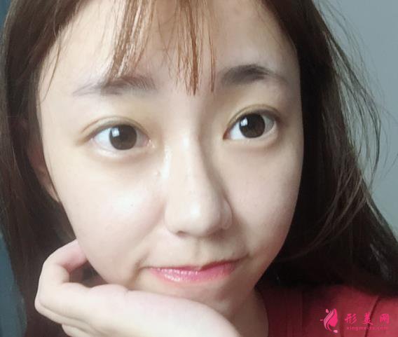 雙眼皮案例：雙眼皮手術(shù)時