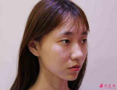 深圳北大醫(yī)院雙眼皮案例之小姐姐的美麗蛻變
