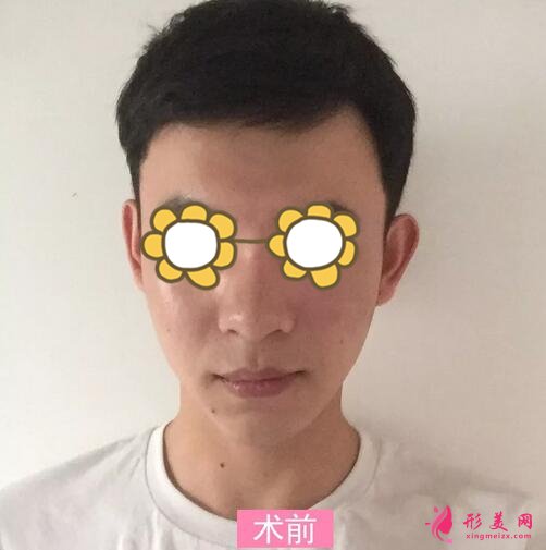 【案例】深圳人民醫(yī)院隆鼻案例，三甲技術(shù)確實(shí)不錯(cuò)！