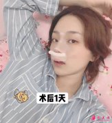 天津市整形外科醫(yī)院怎么樣？隆鼻案例及價格表分享
