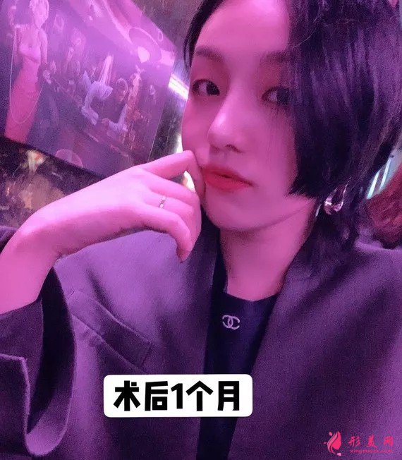 李信鋒做鼻子怎么樣？看看案例圖就知道醫(yī)生技術(shù)了