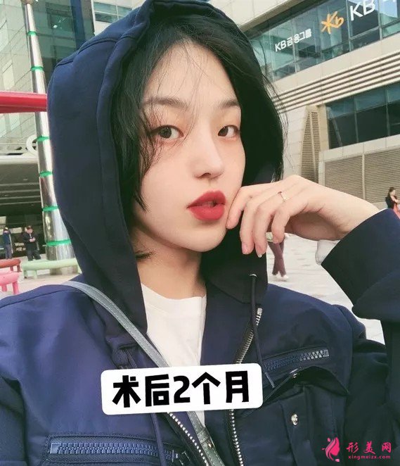 李信鋒做鼻子怎么樣？看看案例圖就知道醫(yī)生技術(shù)了