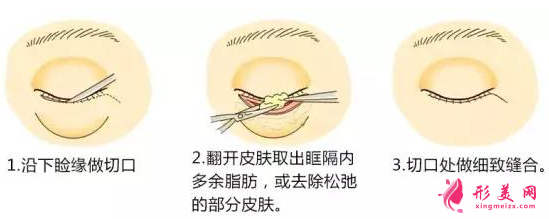 術(shù)后需要注意什么