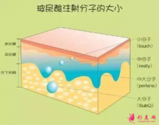玻尿酸豐額頭要多久消腫？