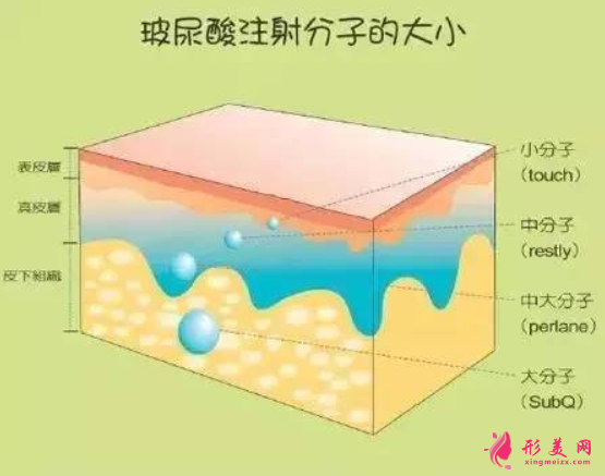 玻尿酸豐額頭要多久消腫