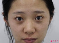 上海交通大學(xué)醫(yī)學(xué)院附屬仁濟(jì)醫(yī)院整形科怎么樣?價(jià)格表+黑臉娃娃美