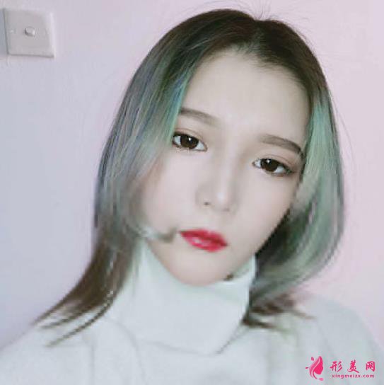 深圳美加美醫(yī)療美容雙眼皮術(shù)后5個(gè)月