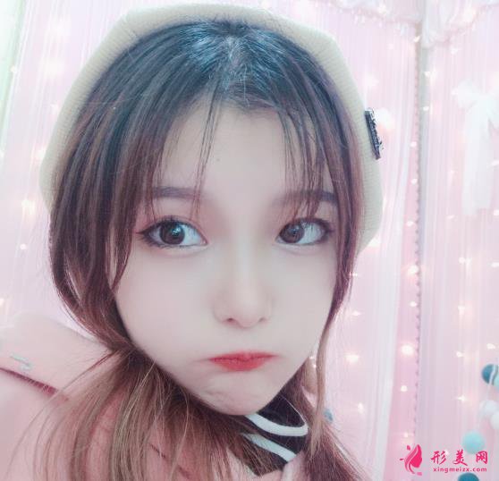 深圳美加美醫(yī)療美容雙眼皮術(shù)后三個(gè)月