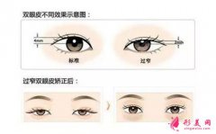 哪些癥狀證明雙眼皮手術(shù)失敗了？