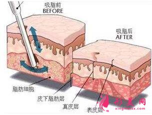 　大腿抽脂填充臉部手術(shù)風(fēng)險大不大？