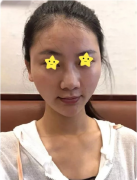 深圳米蘭柏羽美容醫(yī)院隆鼻哪個(gè)醫(yī)生好？附案例分享