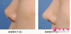 北京整形醫(yī)院鼻尖整形大概多少錢(qián)？