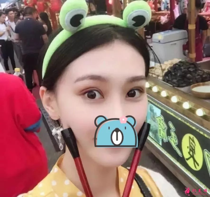 深圳陽光醫(yī)院雙眼皮案例，單眼皮妹子的完美逆襲