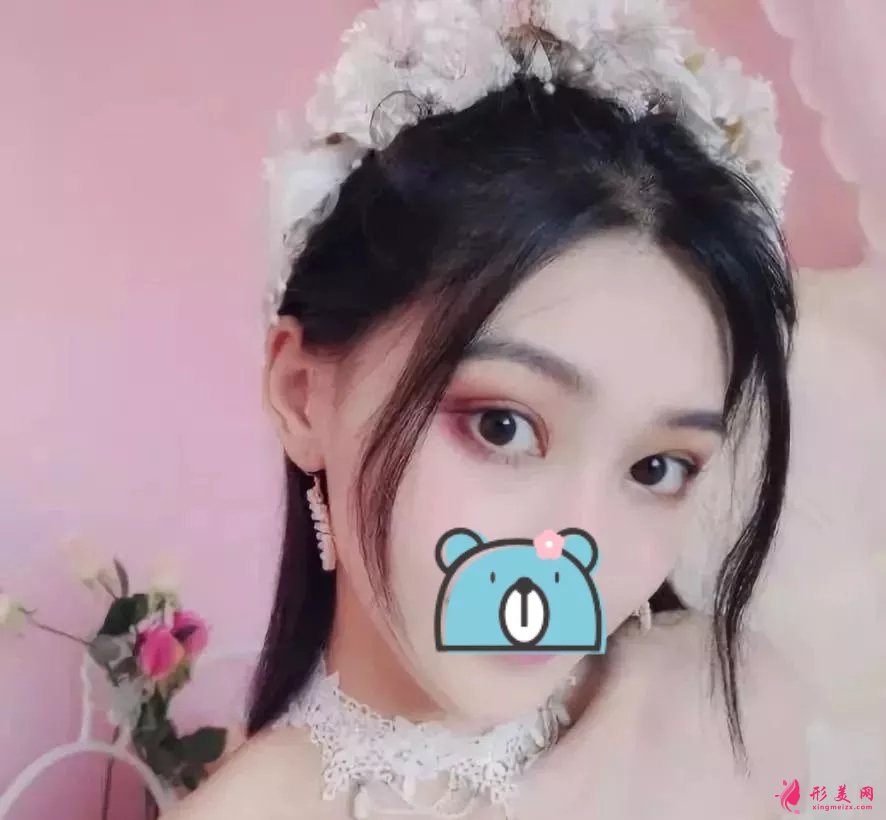 深圳陽光醫(yī)院雙眼皮案例，單眼皮妹子的完美逆襲