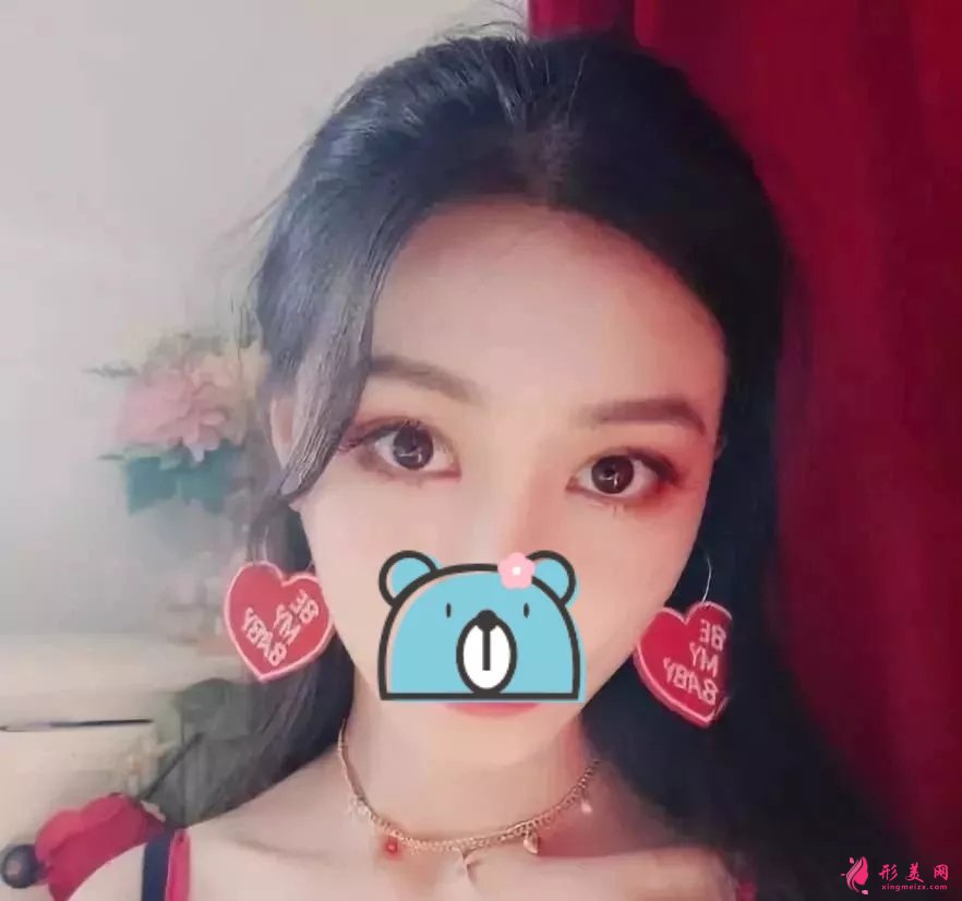 深圳陽光醫(yī)院雙眼皮案例，單眼皮妹子的完美逆襲