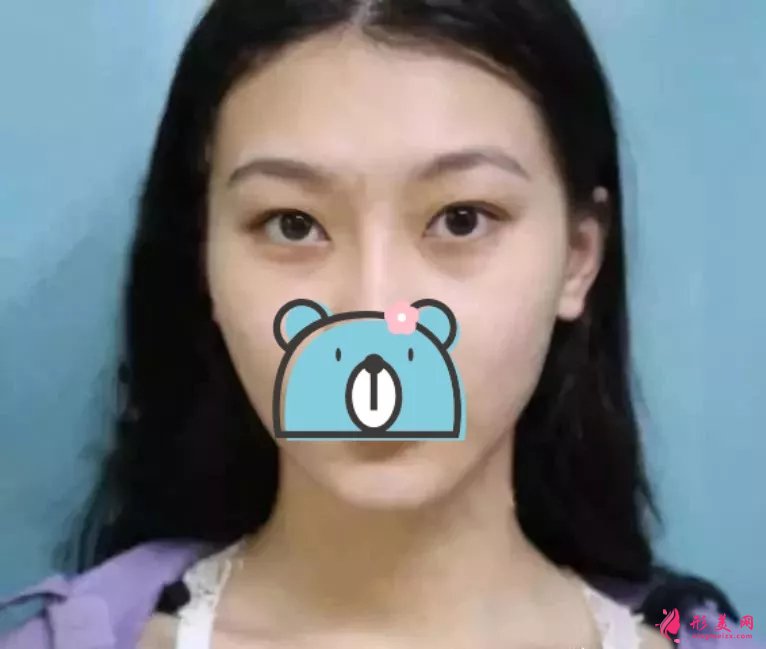 深圳陽光醫(yī)院雙眼皮案例，單眼皮妹子的完美逆襲