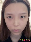 長(zhǎng)沙市一醫(yī)院整形美容雙眼皮案例反饋