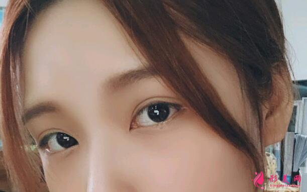 深圳鵬愛(ài)醫(yī)療美容醫(yī)院割雙眼皮案例反饋