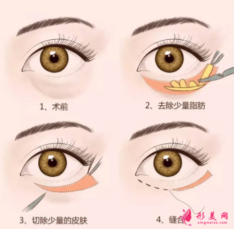 眼袋怎樣消除比較快