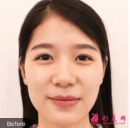 鄭州天后做假體豐額頭怎么樣？案例+價(jià)格表分享
