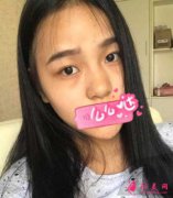 深圳博愛醫(yī)院整形美容科鼻綜合手術(shù)怎么樣？鼻綜合案例分享