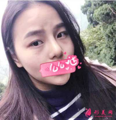 找成都華美紫馨陳楊醫(yī)生做鼻綜合術(shù)后20天