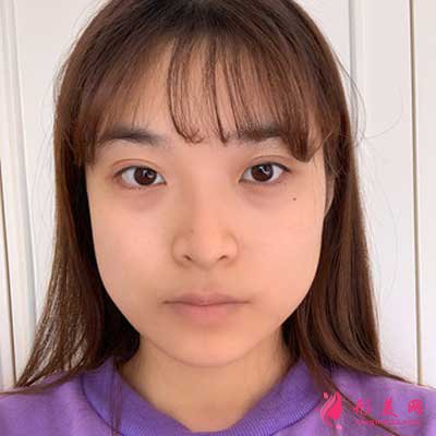 去北京葉子整形醫(yī)院找李明做磨下頜角手術(shù)前