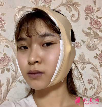 去北京葉子整形醫(yī)院找李明做磨下頜角手術(shù)后7天