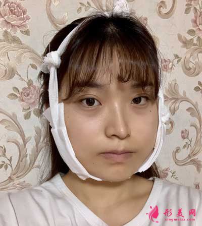 去北京葉子整形醫(yī)院找李明做磨下頜角手術(shù)后3天