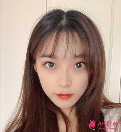 去北京葉子整形醫(yī)院找李明做磨下頜角手術(shù)后20天