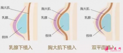 假體隆胸后會下垂嗎？