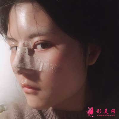 做完隆鼻整形手術(shù)的第5天效果圖展示