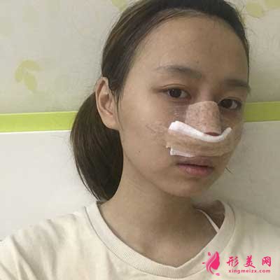 王繼紅醫(yī)生為我做的隆鼻整形手術(shù) 術(shù)后第5天拆鼻夾板